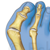 Hallux valgus