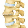 Osteochondrose