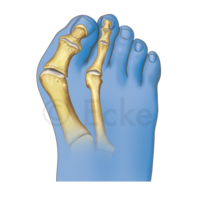 Hallux valgus