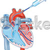 Herzkatheterinjektion