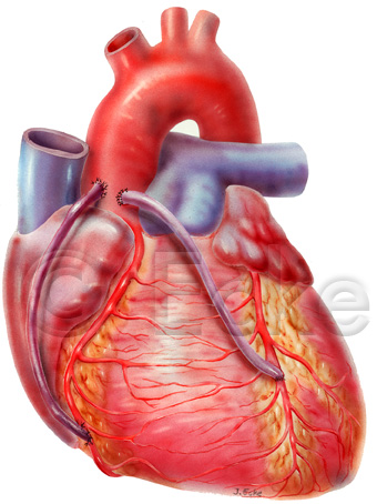 Bypass Herz Koronararterie Aorta