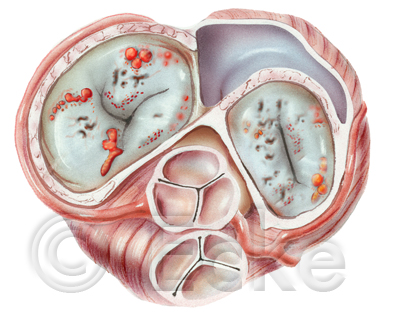 Endocarditis