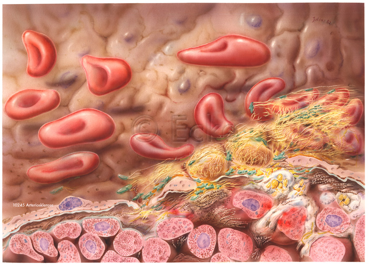 Arteriosklerose 11