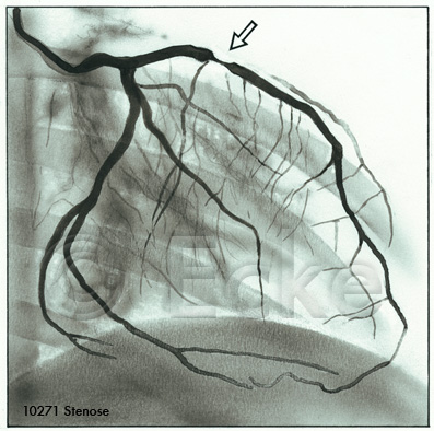 Stenose Koronararterie