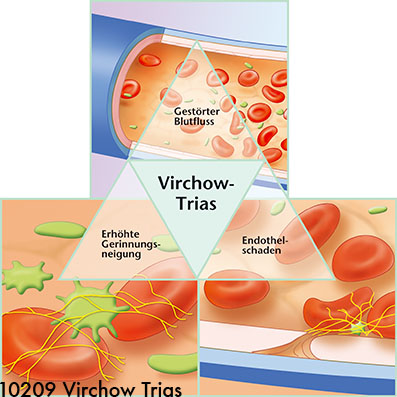 Virchow Trias