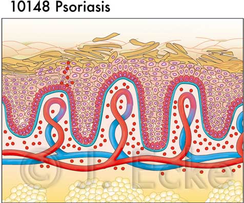 Psoriasis