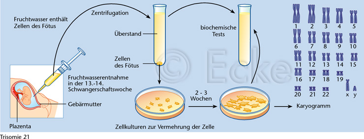 Trisomie 21