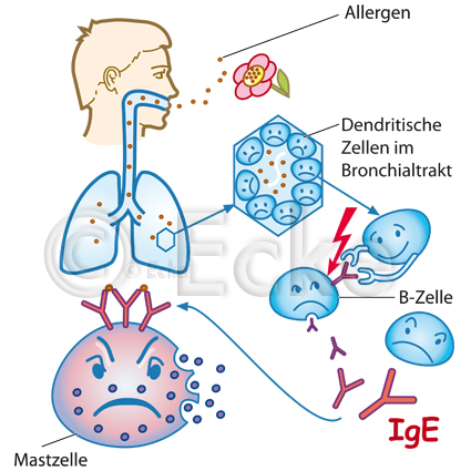 Allergisches Asthma SAA