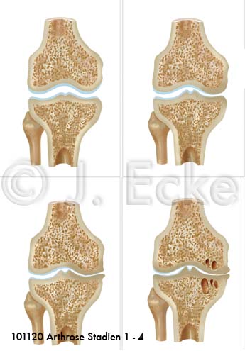 Arthrose 1-4