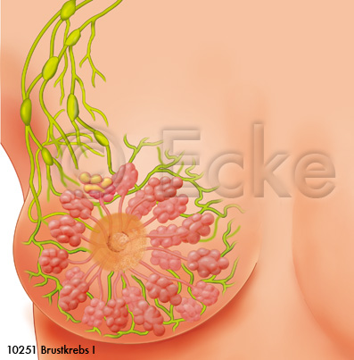 Brustkrebs Stadium 1
