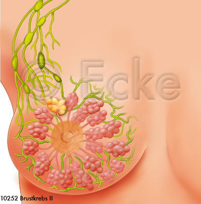 Brustkrebs Stadium 2