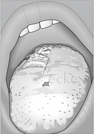 Oral-Candidiasis