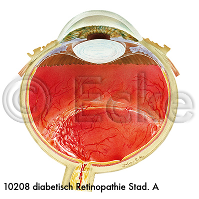 Retinopathie A