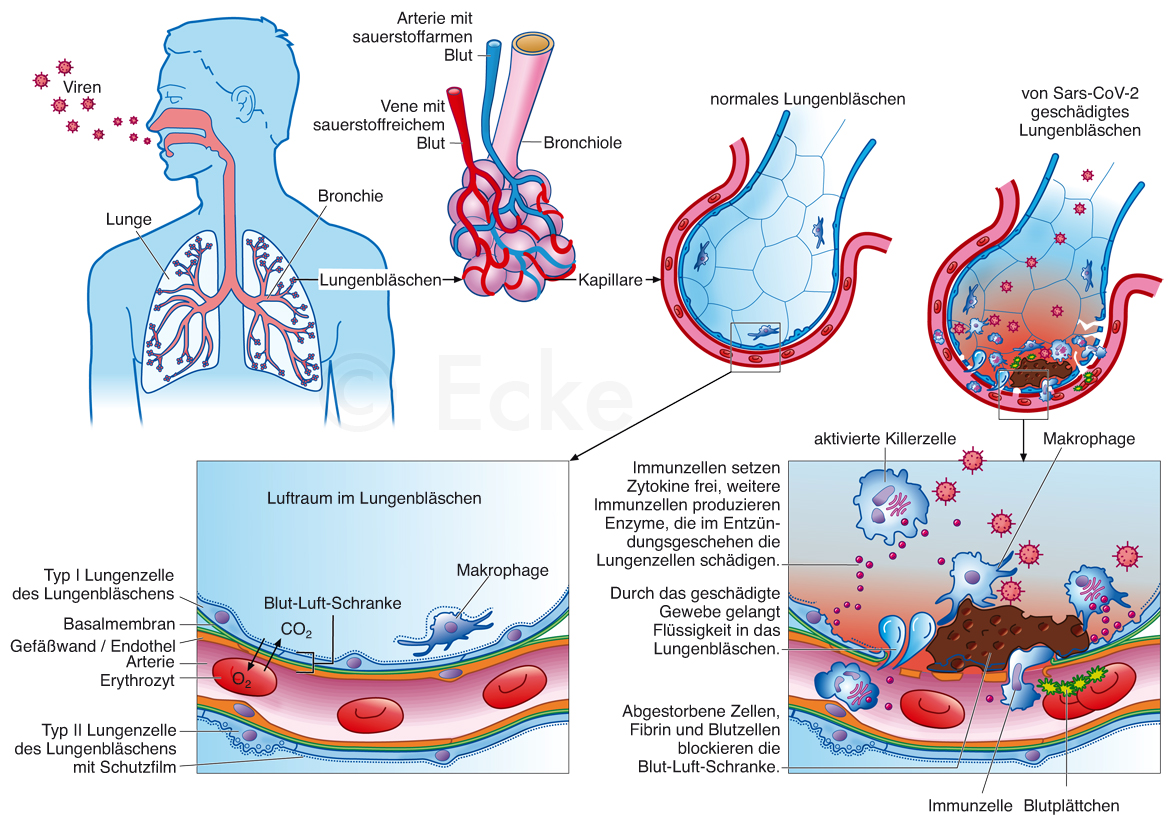 SARS-Cov-2 Infektion Alveole Blut-Luft-Schranke