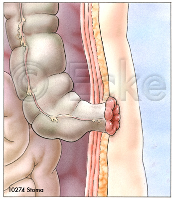 Stoma