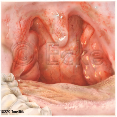 Tonsillitis