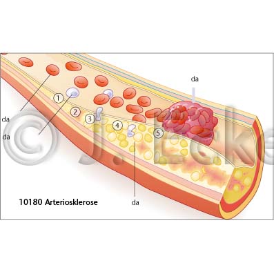 Arteriosklerose