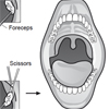 tonsillectomy