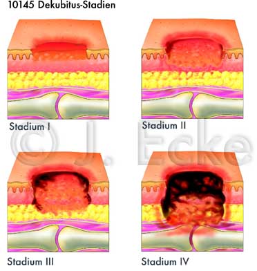 Dekubitus
