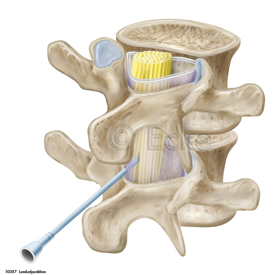 Lumbalpunktion