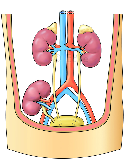 Niere Transplantat