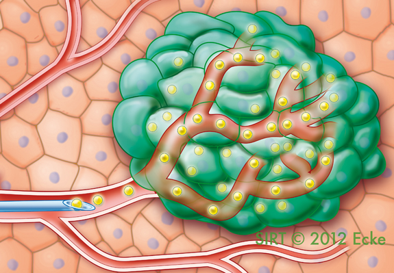 SIRT selektive interne Radiotherapie