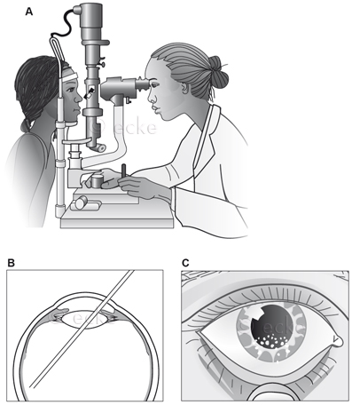 Slit Lamp examination