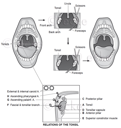 tonsillectomy