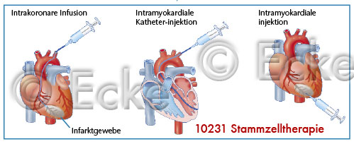 Stammzelltherapie 3